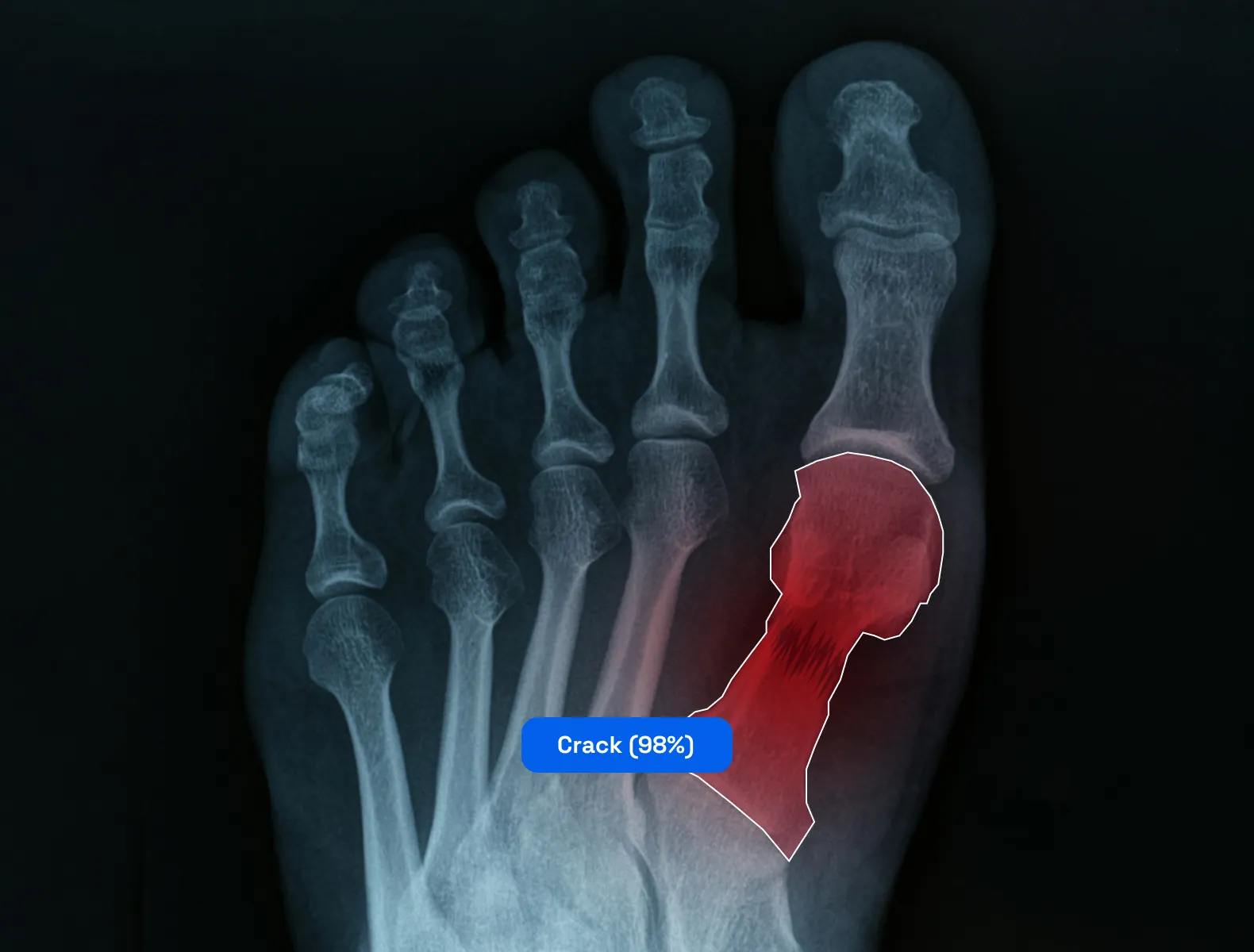 Using image segmentation technique to identify a bone crack in the human skeleton.